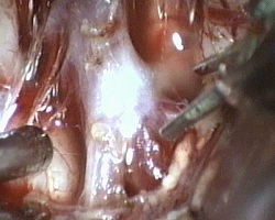applicazione di clip sul colletto dell'aneurisma