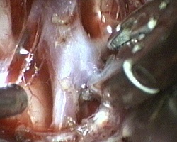 applicazione di clip sul colletto dell'aneurisma