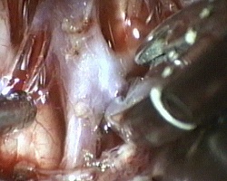applicazione di clip sul colletto dell'aneurisma