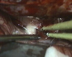 nervo ottico di destra, apertura della cisterna ottico-chiasmatica