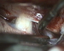nervo ottico di destra e arteria carotide di destra