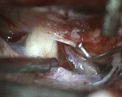 nervo ottico di destra e arteria carotide di destra