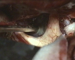 apertura della capsula del craniofaringioma e suo svuotamento
