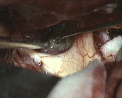 svuotamento del craniofariogioma tra i nervi ottici