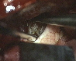 svuotamento del craniofariogioma tra i nervi ottici