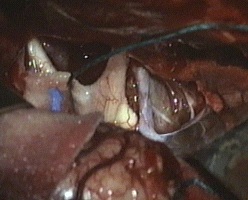 preparazione della porzione laterale destra del craniofaringioma