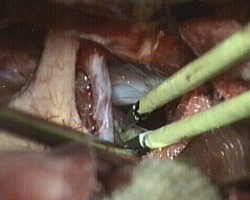 asportazione della porzione laterale destra del craniofaringioma