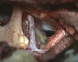 asportazione della porzione laterale destra del craniofaringioma