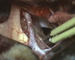 asportazione della porzione laterale destra del craniofaringioma