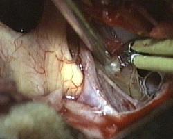 asportazione della porzione laterale destra del craniofaringioma