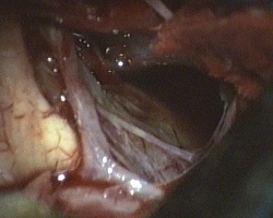 asportazione della porzione laterale destra del craniofaringioma