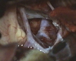 chiasma. arteria carotide di destra, biforcazione della carotide di destra, dorsum sellae e arteria basilare al termine dell'asportazione