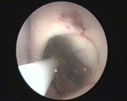 aspirazione della cisti del craniofaringioma