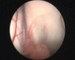 ingresso dell'endoscopio nel ventricolo laterale destro: plesso corioideo, vena talamostriata, margine laterale del forame di Monro occupata dalla cisti
