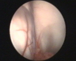 plesso corioideo, margine laterale del forame di Monro occupato dalla cisti e ingresso del corno temporale del ventricolo laterale destro
