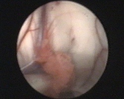 plesso corioideo, margine laterale del forame di Monro occupato dalla cisti, vena talamostriata e ingresso del corno temporale del ventricolo laterale destro