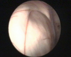 forame di Monro occupato dalla cisti del craniofaringioma