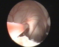 perforazione della cisti con l'ausilio di catetere di Fogarty introdotto attraverso il canale di lavoro dell'endoscopio