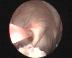 perforazione della cisti con l'ausilio di catetere di Fogarty introdotto attraverso il canale di lavoro dell'endoscopio