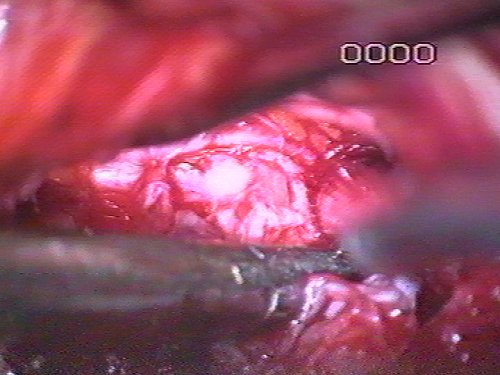 discectomia