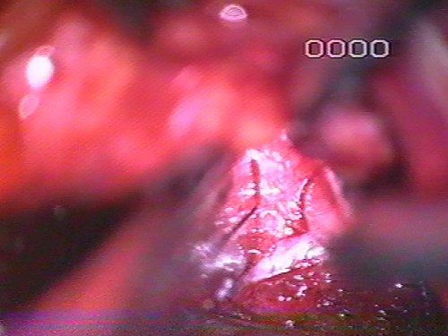 discectomia