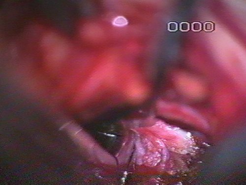 discectomia