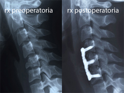 frattura cervicale