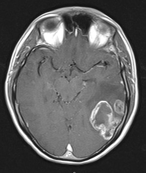 RM encefalo preoperatoria