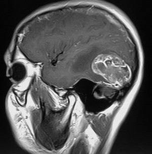 RM encefalo preoperatoria