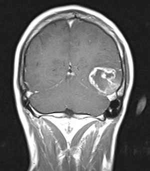 RM encefalo preoperatoria