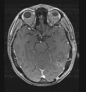RM postoperatoria