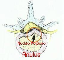 protrusione del disco