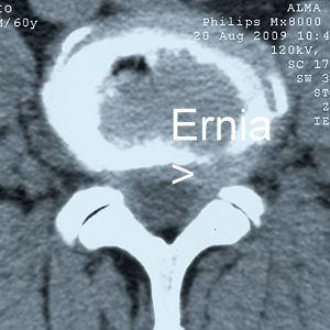 TC ernia del disco