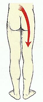 sciatalgia