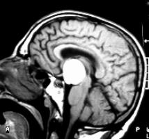 Craniofaringioma cistico