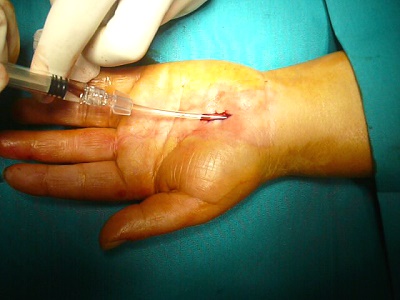 applicazione Hyaloglide