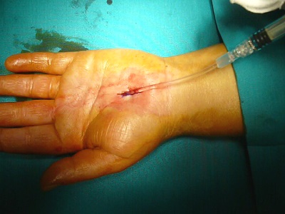 applicazione Hyaloglide