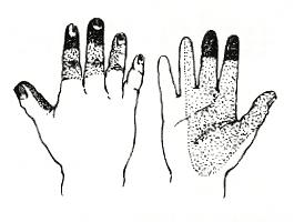 perdita sensibilit alle dita della mano