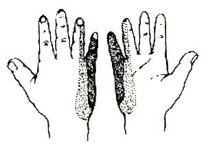 Parestesie alla mano (4° e 5° dito)