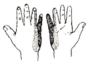 Parestesie alla mano (4 e 5 dito)