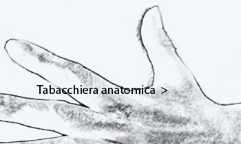 Tabacchiera anatomica (atrofia del primo inteosseo dorsale e dell’adduttore del pollice)