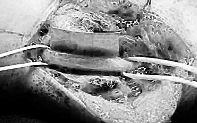 Preparazione alla plastica del canale epitrocleo-olecranico con dura di banca