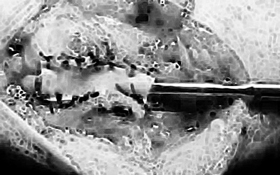 Verifica della giusta tensione del nuovo canale prima dell'introduzione del gel antiaderenziale (Hyaloglide)