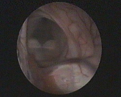 ingresso dell'endoscopio ner ventricolo laterale destro: forame di Monro, plesso corioideo, setto pellucido fenestrato e 3 ventricolo con corpi mammillari