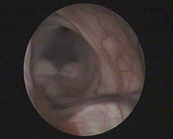 forame di Monro, plesso corioideo, setto pellucido fenestrato e 3 ventricolo con corpi mammillari