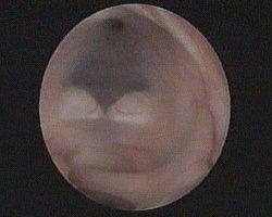 terzo ventricolo: corpi mammillari, tuber cinereum, adesio intertalamica