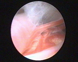 arterie nella cisterna interpeduncolare